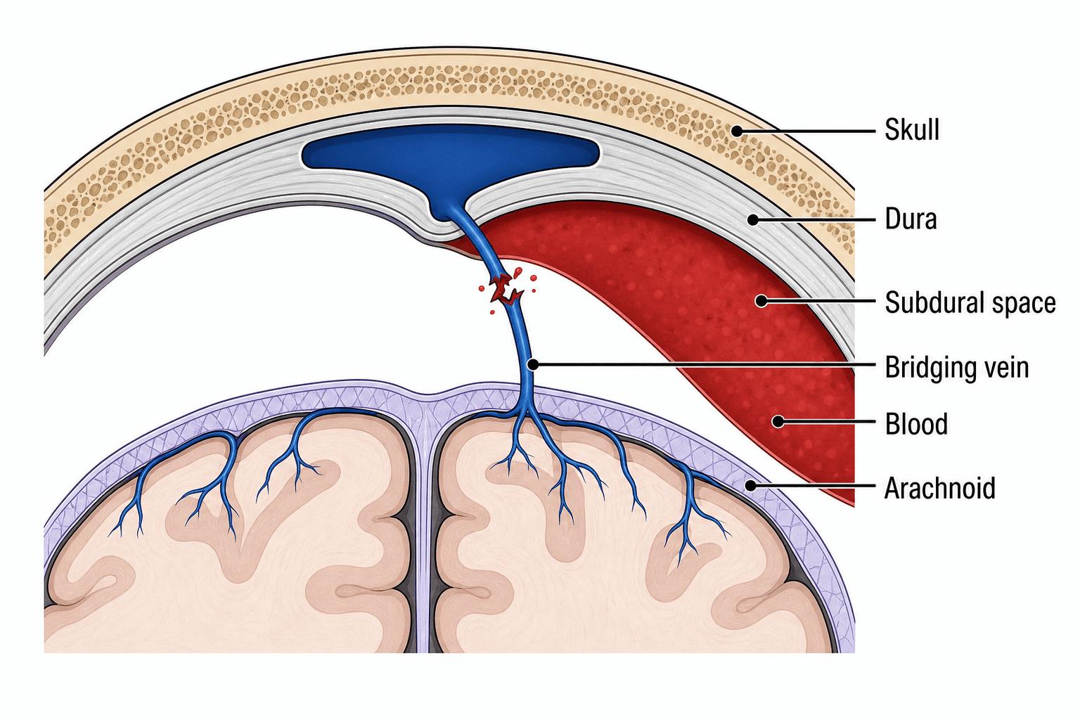 Verletzungsmechanismus der Brückenvenen — Eine Brückenvene, die auf ihrem Weg von der Kortexoberfläche zum Duralsinus gerissen ist, mit Blut, das sich im Subduralraum sammelt, und beschrifteten Hirnhautschichten.